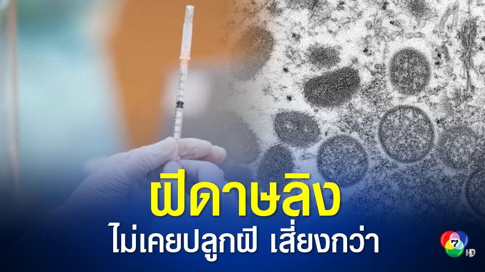 “ฝีดาษลิง” จากสัตว์สู่คนโอกาสน้อย แต่ต้องเฝ้าระวัง คนเกิดหลังปี 23 ไม่เคยฉีดวัคซีนไข้ทรพิษเสี่ยงกว่า