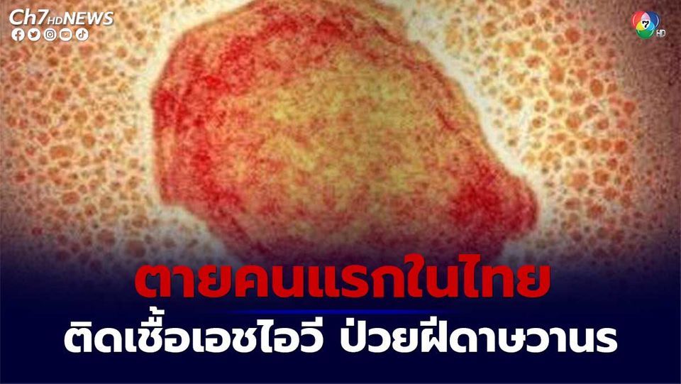 ตายคนแรกในไทย ติดเชื้อเอชไอวี ป่วยฝีดาษวานร