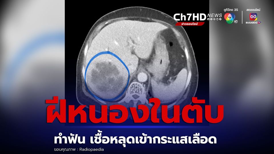 ฝีหนองในตับ ทำฟันเชื้อเข้ากระแสเลือดหลุดเข้าตับ หมอเตือนไขมันพอกตับติดเชื้อ-เป็นฝีง่าย