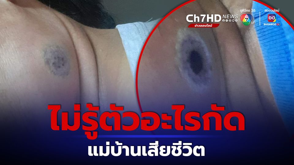 แม่บ้านไม่รู้ตัวอะไรกัด เป็นแผลบวม ป่วยซึม สุดท้ายเสียชีวิต