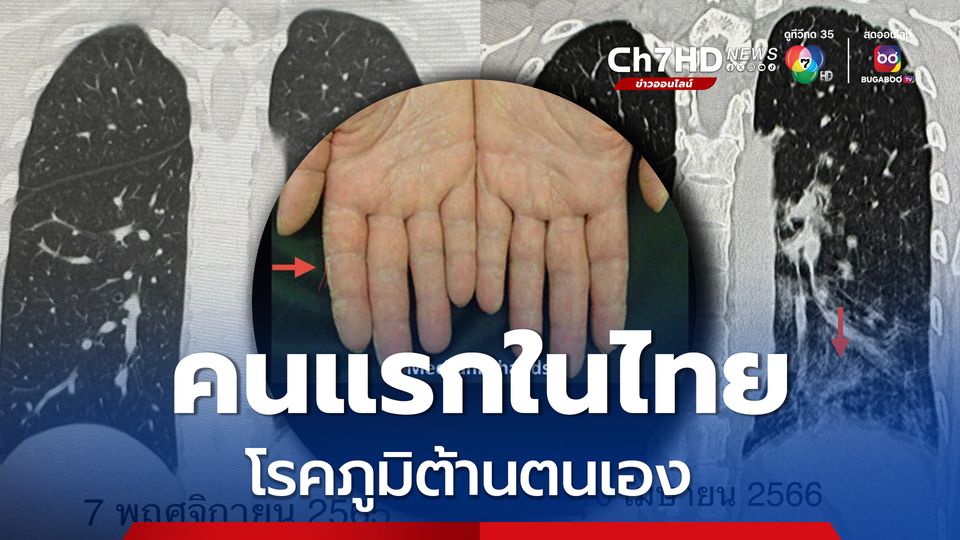 โรคภูมิต้านตนเอง หมอมนูญเตือนใครเกิดโรคนี้ห้ามฉีด mRNA เข็มต่อไป