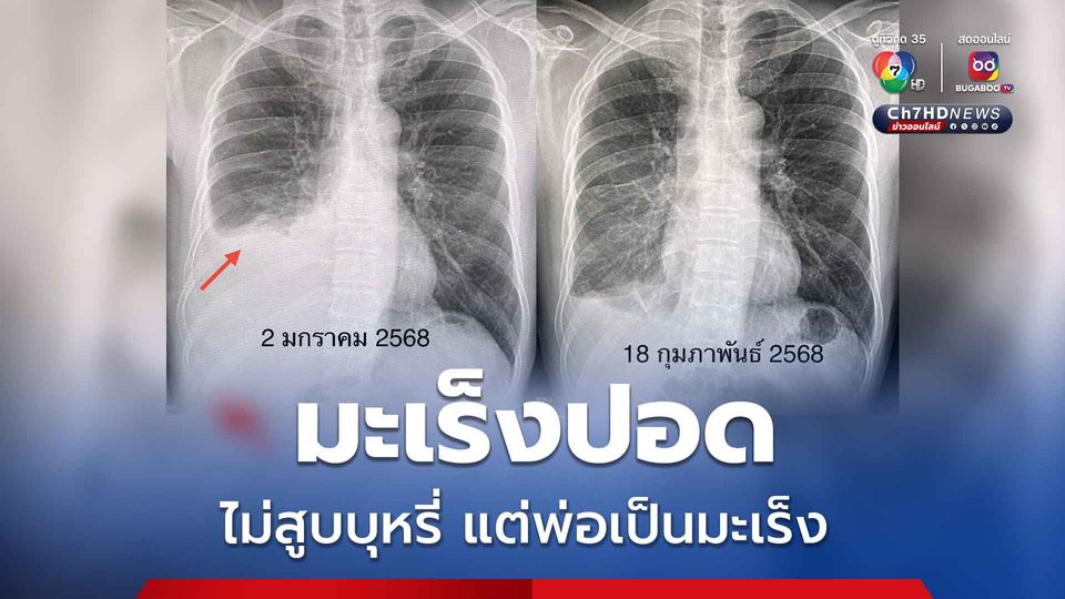 หมอมนูญ ยกเคสผู้ป่วยไม่เคยสูบบุหรี่ แต่พ่อเป็นมะเร็ง ตรวจพบมะเร็งปอด