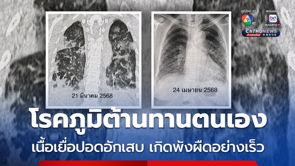 ปอดอักเสบทั้ง 2 ข้าง จากโรคภูมิต้านทานตนเอง
