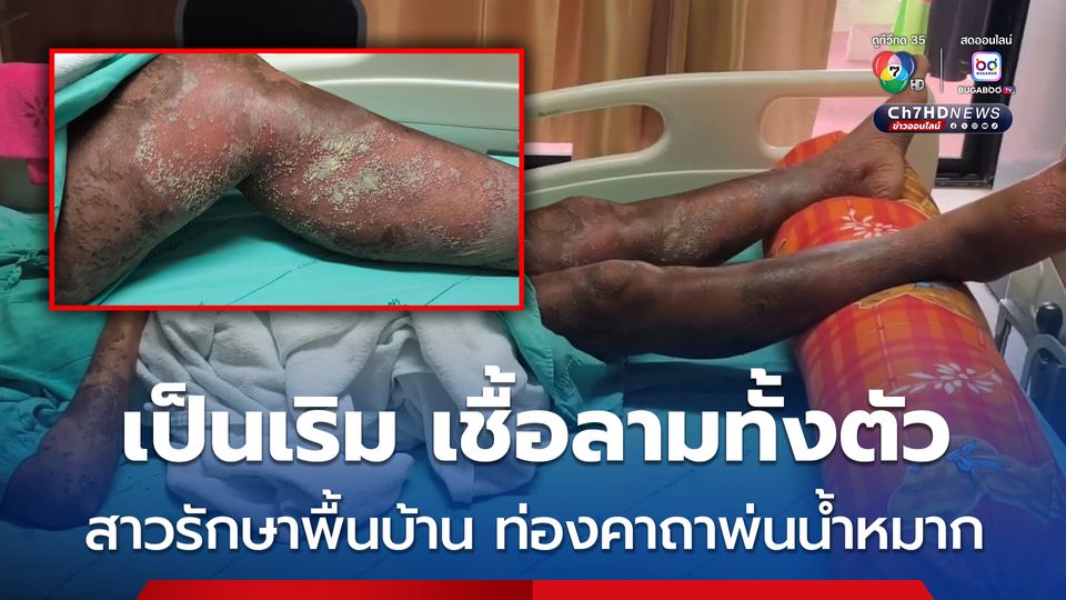 อุทาหรณ์ สาวแม่ค้าขายผักป่วยเป็นเริม รักษาพื้นบ้าน ท่องคาถาพ่นน้ำหมาก เชื้อลามทั้งตัว ติดเชื้อในกระแสเลือด