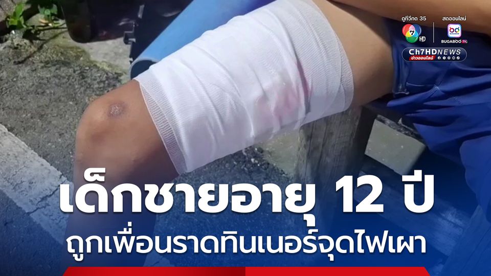 เด็ก 12 ถูกเพื่อนราดทินเนอร์จุดไฟเผา ยันไม่มีเหตุทะเลาะกัน