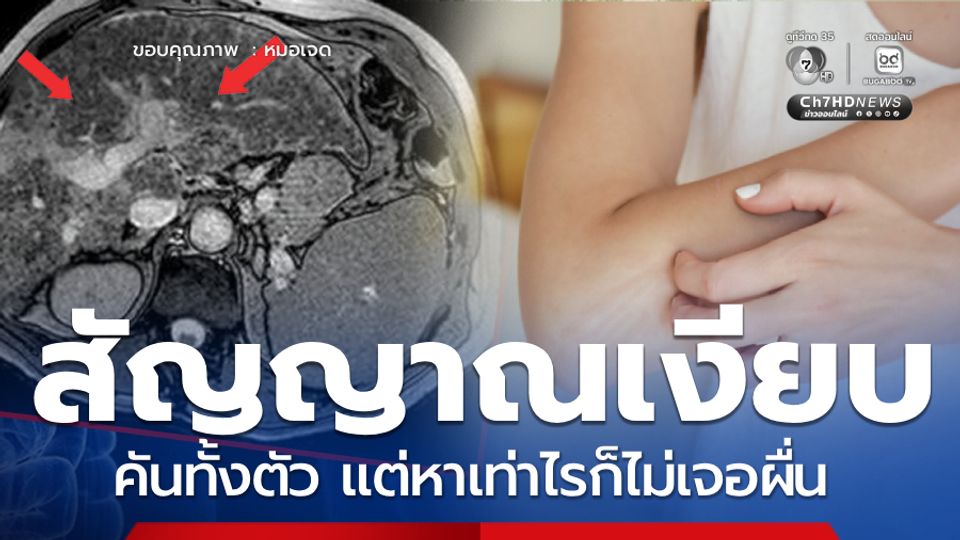 หมอเจดเตือน สัญญาณเงียบ คันทั้งตัว แต่หาเท่าไรก็ไม่เจอผื่น