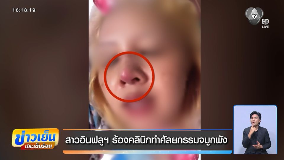 สาวอินฟลูฯ ร้องคลินิกทำศัลยกรรมจมูกพัง
