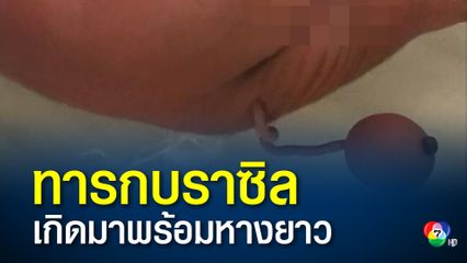 ทารกน้อยชาวบราซิลเกิดมามีหางยาวโผล่ตรงก้น