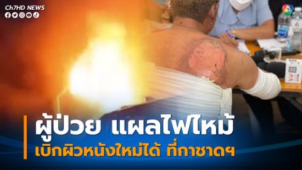 เพจหมอเวร ระบุ ผู้ป่วย แผลไฟไหม้ เบิกผิวหนังใหม่ได้ ที่สภากาชาดไทย
