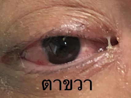 โควิด XBB.1.16 ตาแดง หมอมนูญยกเคสชายไทยป่วย คาดติดเชื้อจาก ตปท.