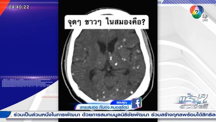 เตือน กินผักสด ไม่ล้าง เสี่ยงพยาธิขึ้นสมอง