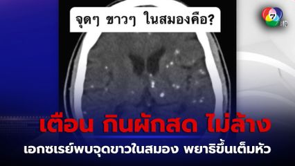 เตือน กินผักสด ไม่ล้าง เสี่ยงพยาธิขึ้นสมอง