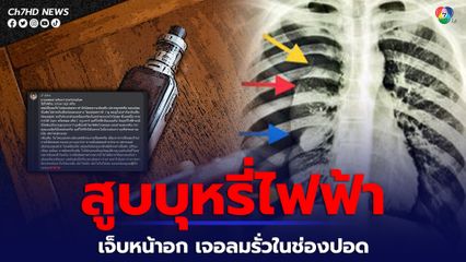 อุทาหรณ์! นักสูบบุหรี่ไฟฟ้า หมอเผย หนุ่ม 16 เจ็บหน้าอกเวลาหายใจ พบลมรั่วในช่องปอด