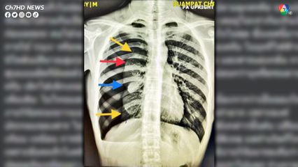 อุทาหรณ์! นักสูบบุหรี่ไฟฟ้า หมอเผย หนุ่ม 16 เจ็บหน้าอกเวลาหายใจ พบลมรั่วในช่องปอด