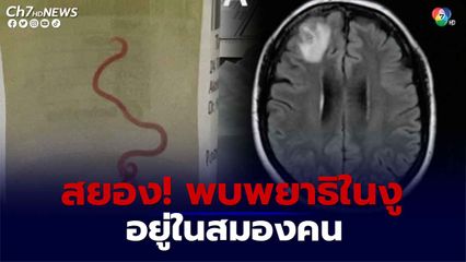 ออสเตรเลียพบพยาธิตัวกลมเป็น ๆ ยาว 8 ซม. เป็นครั้งแรกในโลกที่พบพยาธิดังกล่าวในมนุษย์ 