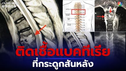 "หมอมนูญ" เผยเคสผู้ป่วยติดเชื้อแบคทีเรียที่กระดูกสันหลัง อาการคล้ายวัณโรค