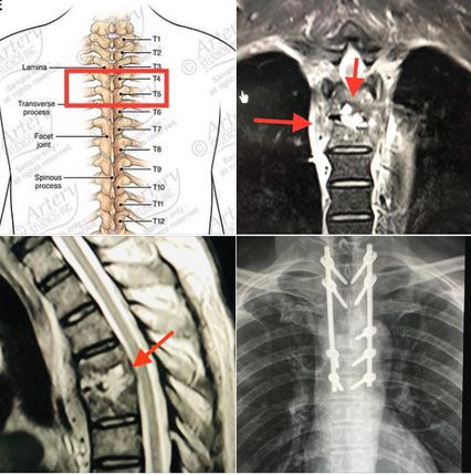 "หมอมนูญ" เผยเคสผู้ป่วยติดเชื้อแบคทีเรียที่กระดูกสันหลัง อาการคล้ายวัณโรค