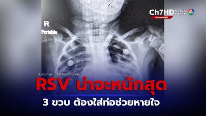 หมอจิรรุจน์ ยกเคส RSV อาการหนัก เด็ก 3 ขวบ เชื้อลงปอดต้องใส่ท่อช่วยหายใจ