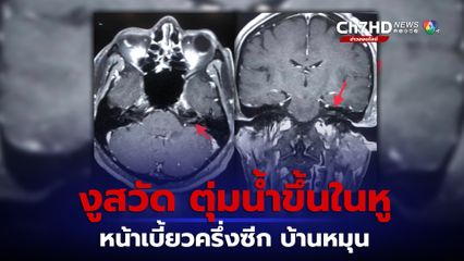 งูสวัด ตุ่มน้ำขึ้นในหู หน้าเบี้ยวครึ่งซีก "หมอมนูญ" เตือนพบบ่อยในคนอายุ 50 ปีขึ้นไป