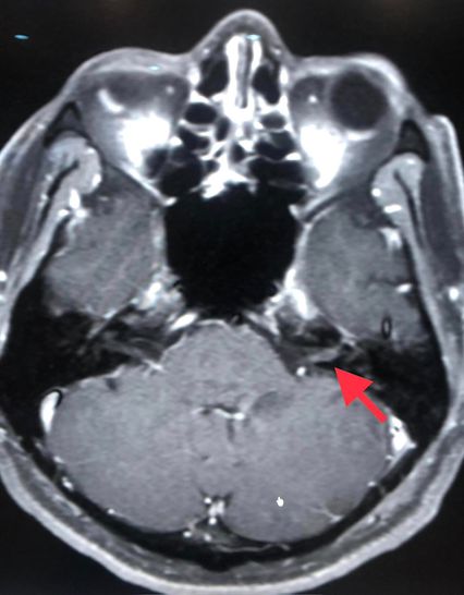 งูสวัด ตุ่มน้ำขึ้นในหู หน้าเบี้ยวครึ่งซีก "หมอมนูญ" เตือนพบบ่อยในคนอายุ 50 ปีขึ้นไป