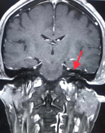 งูสวัด ตุ่มน้ำขึ้นในหู หน้าเบี้ยวครึ่งซีก "หมอมนูญ" เตือนพบบ่อยในคนอายุ 50 ปีขึ้นไป