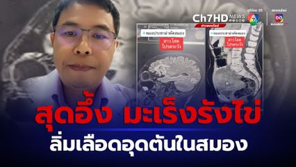 คนไข้พูดจาสับสน-สมองตาย ผลตรวจสุดอึ้งมะเร็งรังไข่ ทำให้ลิ่มเลือดอุดตัน