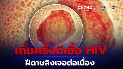 ฝีดาษลิง เจอต่อเนื่อง สัปดาห์เดียวป่วยเพิ่ม 42 คน เกินครึ่งมีเชื้อ HIV