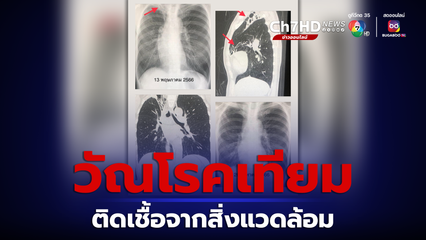 วัณโรคเทียมติดเชื้อจากสิ่งแวดล้อม "หมอมนูญ" ยกเคสผู้ป่วยหญิงไอเป็นเลือด