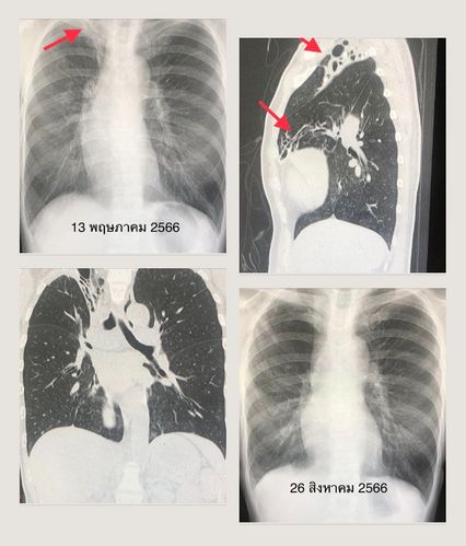 วัณโรคเทียมติดเชื้อจากสิ่งแวดล้อม "หมอมนูญ" ยกเคสผู้ป่วยหญิงไอเป็นเลือด