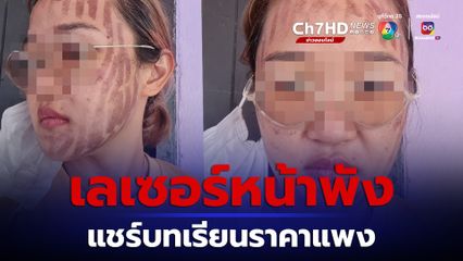 สาวแชร์อุทาหรณ์ เลเซอร์ทำพิษหน้าพัง รอยไหม้ขึ้นเป็นแถบ ลั่น เจ็บเหมือนเอาเตารีดนาบหน้า