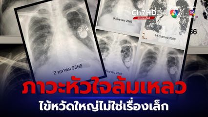 "หมอมนูญ" ยกเคสเตือนไข้หวัดใหญ่ระบาด ผู้สูงอายุปอดอักเสบ เกิดภาวะหัวใจล้มเหลว