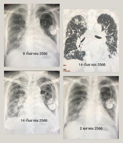 "หมอมนูญ" ยกเคสเตือนไข้หวัดใหญ่ระบาด ผู้สูงอายุปอดอักเสบ เกิดภาวะหัวใจล้มเหลว