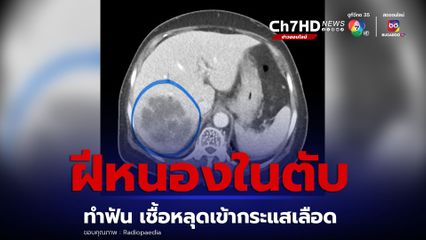 ฝีหนองในตับ ทำฟันเชื้อเข้ากระแสเลือดหลุดเข้าตับ หมอเตือนไขมันพอกตับติดเชื้อ-เป็นฝีง่าย