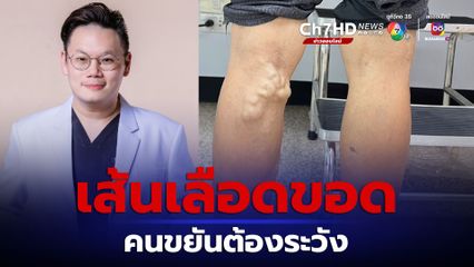 เส้นเลือดขอด ไม่ใช่แค่เรื่องความสวยงาม หมอแนะคนขยันต้องระวัง