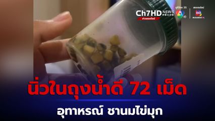 อุทาหรณ์คนกินชานมไข่มุก นิ่วในถุงน้ำดี 72 เม็ด