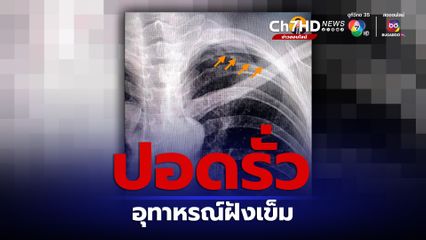 อุทาหรณ์! ฝังเข็มแล้วปอดรั่ว ถ้าขึ้นเครื่องบินมีโอกาสเสียชีวิต
