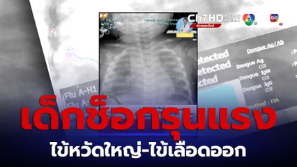 ทารก 10 เดือน ช็อกรุนแรง ติดเชื้อไข้หวัดใหญ่กับไข้เลือดออก