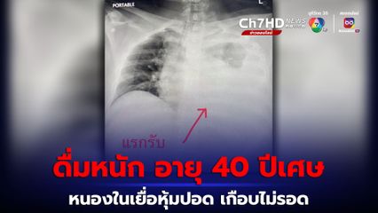 ป่วยเบาหวานดื่มหนัก อายุ 40 ปีเศษ ติดเชื้อในปอดเกือบเอาชีวิตไม่รอด