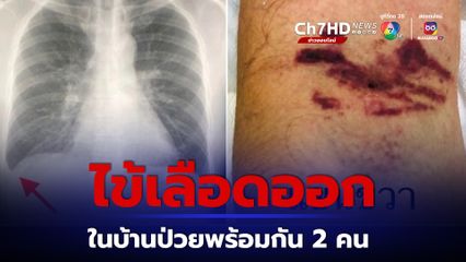 ไข้เลือดออก หมอมนูญยกเคสเกล็ดเลือดต่ำ ในบ้านป่วยพร้อมกัน 2 คน