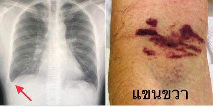 ไข้เลือดออก หมอมนูญยกเคสเกล็ดเลือดต่ำ ในบ้านป่วยพร้อมกัน 2 คน