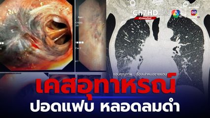 ปอดแฟบ หลอดลมดำ หมอยกเป็นเคสอุทาหรณ์การสัมผัสฝุ่นควันดำ
