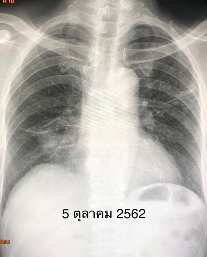 หมอมนูญยกเคสผู้ป่วยวัณโรคปอด แพ้ยาทำตับอักเสบ