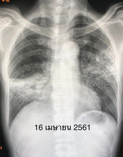 หมอมนูญยกเคสผู้ป่วยวัณโรคปอด แพ้ยาทำตับอักเสบ
