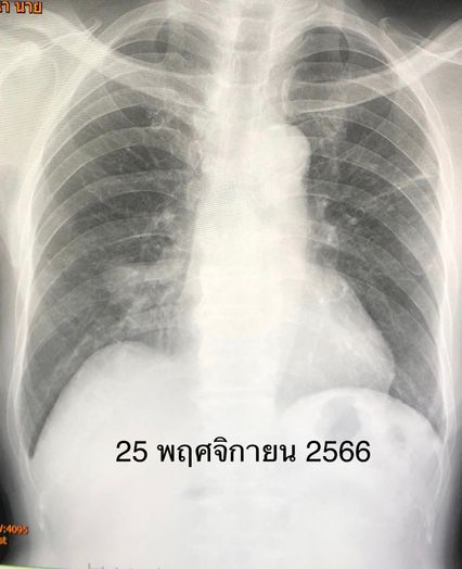 หมอมนูญยกเคสผู้ป่วยวัณโรคปอด แพ้ยาทำตับอักเสบ