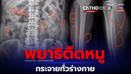 ศูนย์วิจัยโรคปรสิตยกเคสเตือน พยาธิตืดหมูกระจายทั่วร่างกาย