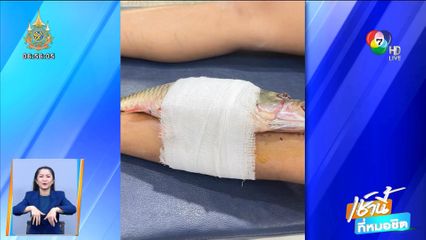 เอ็นดู เด็กถูกเบ็ดเกี่ยวขา ยังห่วงอาหารเย็น จ.ขอนแก่น