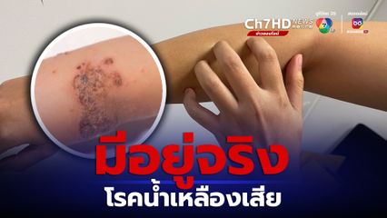 อย่าชะล่าใจ โรคน้ำเหลืองเสีย มีอยู่จริง ผู้มีอาการควรพบแพทย์ ก่อนโรคจะลุกลาม