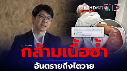 หมอสมอง เผยเคสนักมวยถูกเตะ 58 ครั้ง จนกล้ามเนื้อช้ำ อันตรายอาจถึงไตวาย