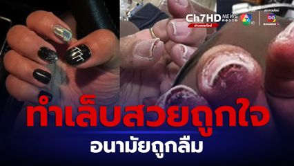 สาวแชร์ประสบการณ์ ไปทำเล็บ ได้เล็บสวยถูกใจ แต่ไม่นานกลับติดเชื้อที่นิ้วมือ