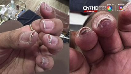 สาวแชร์ประสบการณ์ ไปทำเล็บ ได้เล็บสวยถูกใจ แต่ไม่นานกลับติดเชื้อที่นิ้วมือ